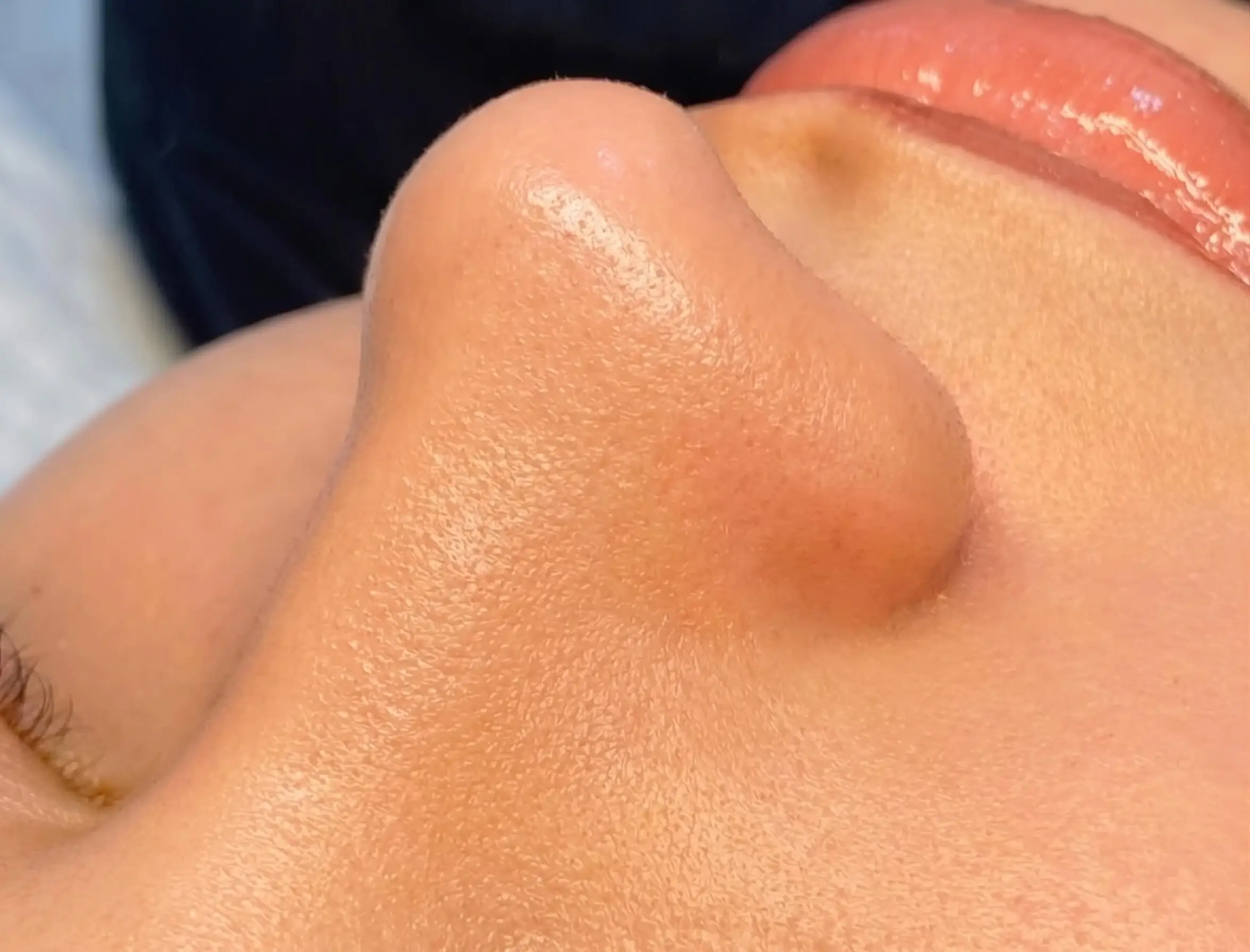 Après Hydrafacial & Pores Purifiés